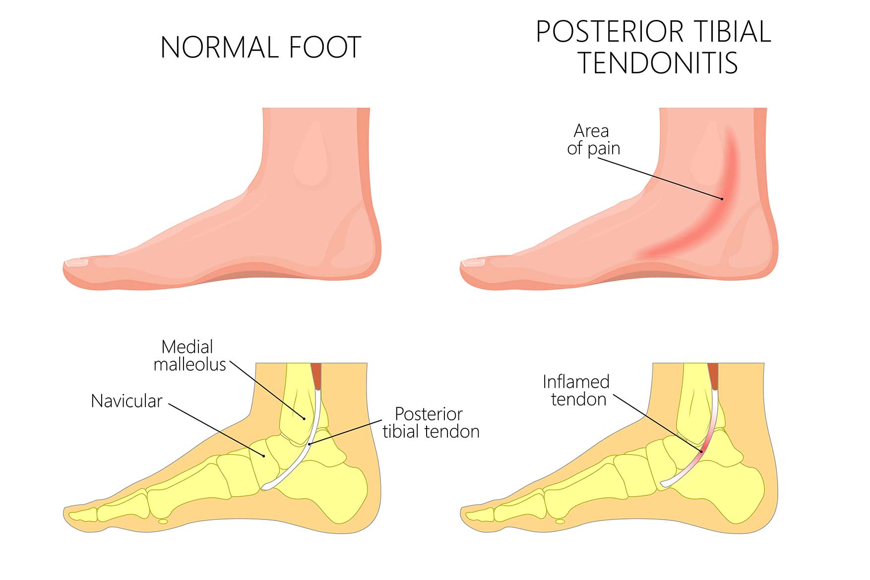 tendinitis tibial posterior - tengo pies planos