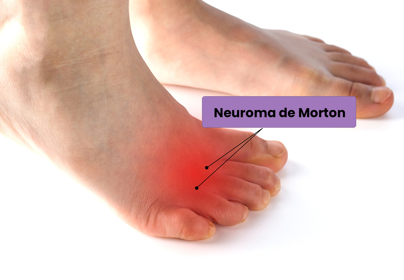 tratamiento del neuroma de Morton - A pie de Calle