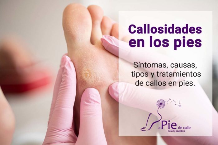 Callosidades En Los Pies Tipos Y Tratamiento Callos 7619