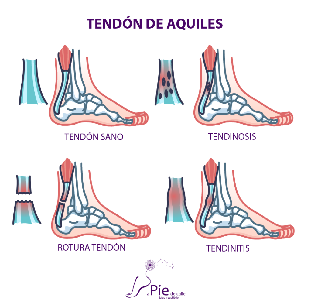 lesiones comunes del tendón de Aquiles 