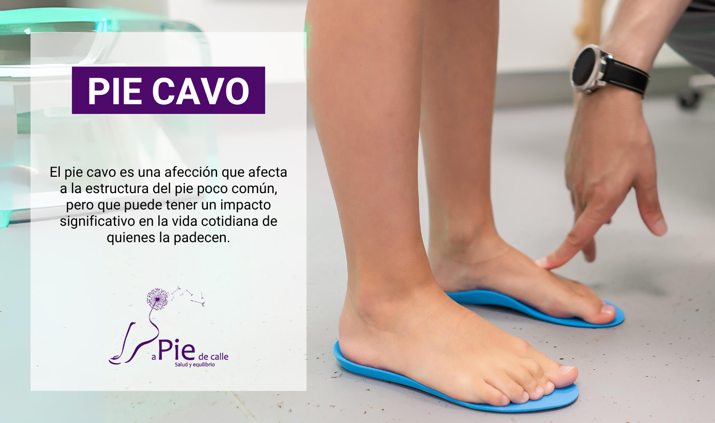 pie cavo, sintomas y tratamiento