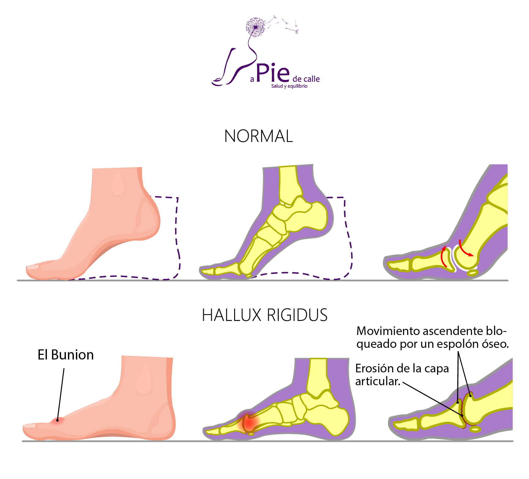 hallux rigidus